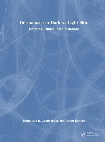 Dermatoses in Dark Vs Light Skin