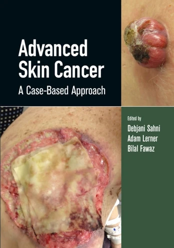 Advanced Skin Cancer