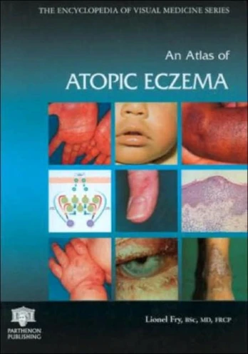 Atlas of Atopic Eczema