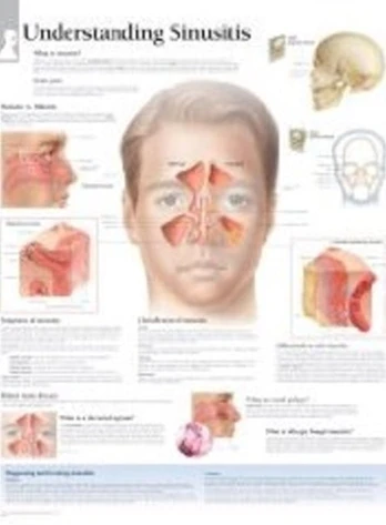 Understanding Sinusitis Laminated Poster