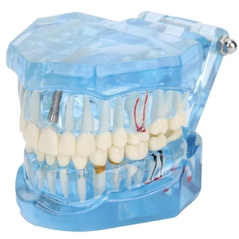 Verk Group Dental modelis jaw teeth teeth implants