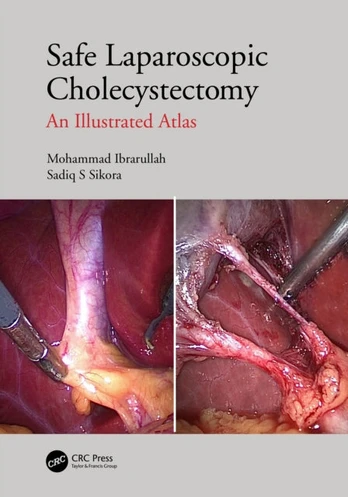 Safe Laparoscopic Cholecystectomy